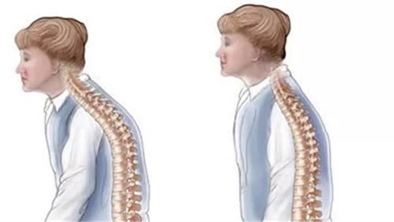 علاج الظهر المنحني.. أسبابه وطرق الشفاء منه والوقاية منه في المنزل 