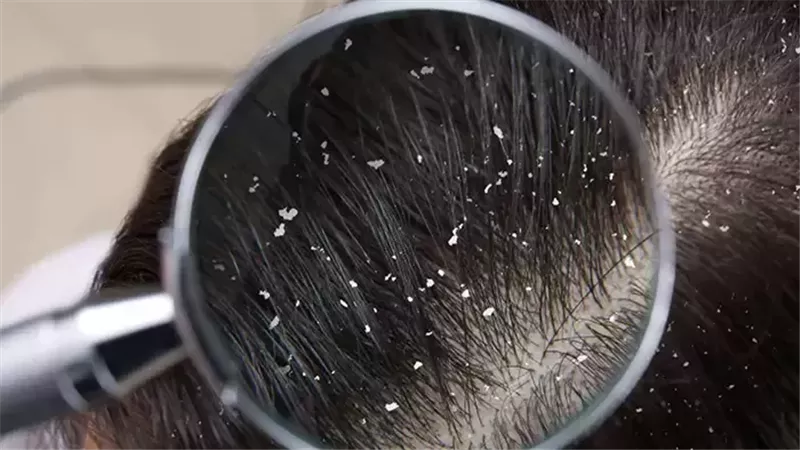 طرق علاج القشرة.. وأبرز الأسباب والأنواع