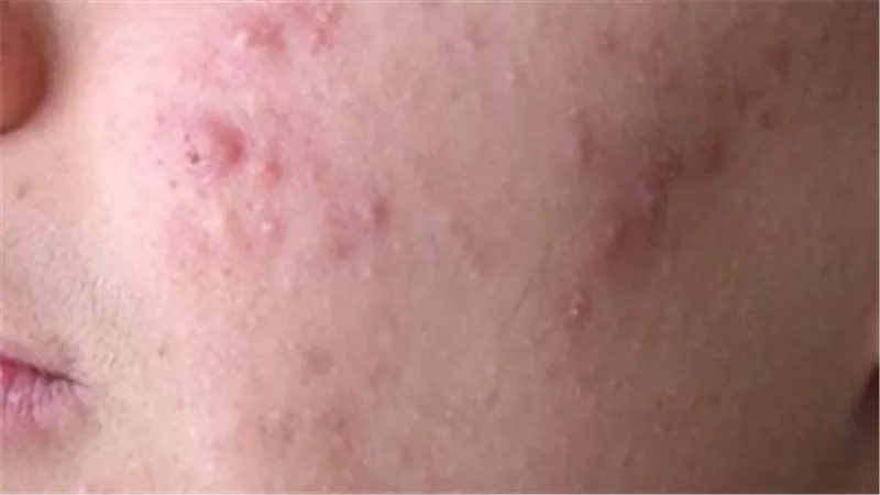 احذري... ماسكات طبيعية منزلية تدمر بشرتك
