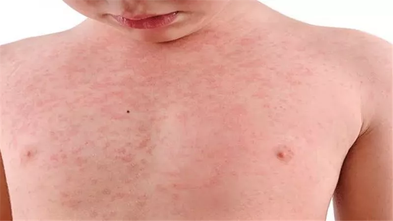 أعراض مرض الحصبة عند الاطفال وكيفية الوقاية منه وطرق العلاج