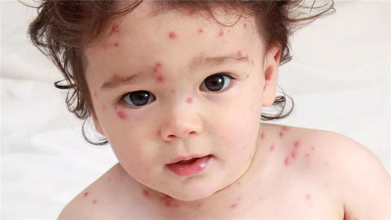 مرض الجدري.. أسبابه وأنواعه وأعراضه وعلاجه 
