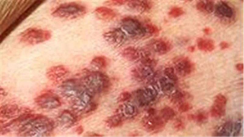 مرض الإيدز.. أسبابه وتشخيصه وطرق علاجه