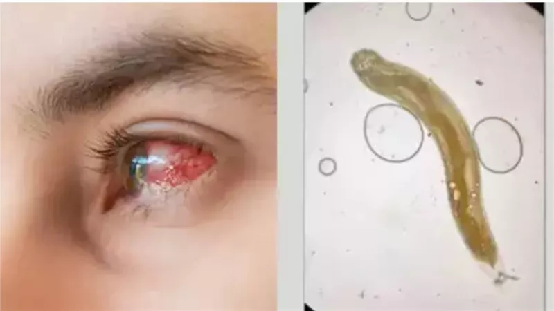 أطباء يزيلون دودة حية من عين رجل.. تعرف على الطريقة التي دخلت بها!