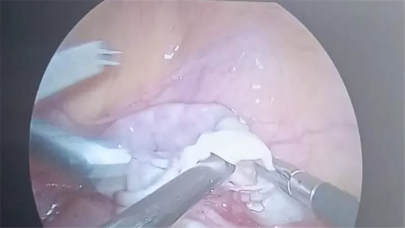 المنيا تشهد إنجازًا طبيًا جديدًا.. نجاح أولى جراحات مناظير النساء بمستشفى مطاي