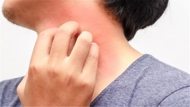 أسباب الحكة في الجسم.. أنواعها ومتى تستدعي العلاج العاجل
