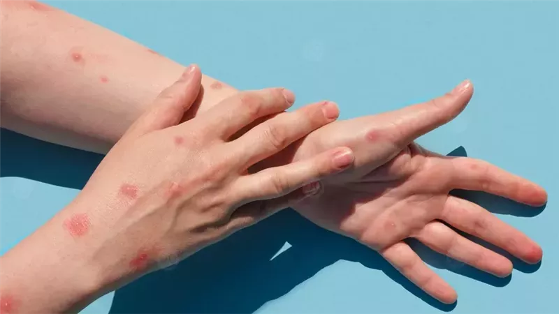 ظهور بقع على الجلد يشير لأمراض خطيرة.. متى تستشير الطبيب؟