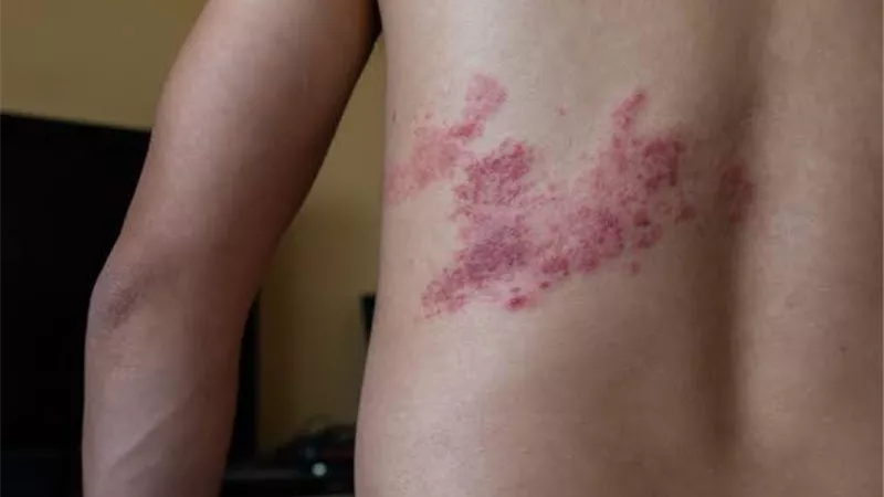 «الحزام الناري».. ألم لا يُحتمل ووقاية ممكنة.. طبيب جلدية يوضح 