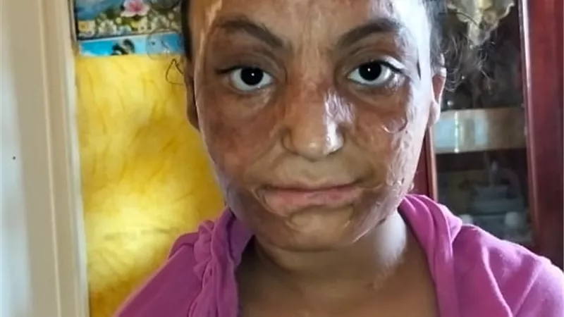 5 سنوات من الألم.. طفلة تحارب آثار الحروق والتنمر في الفيوم