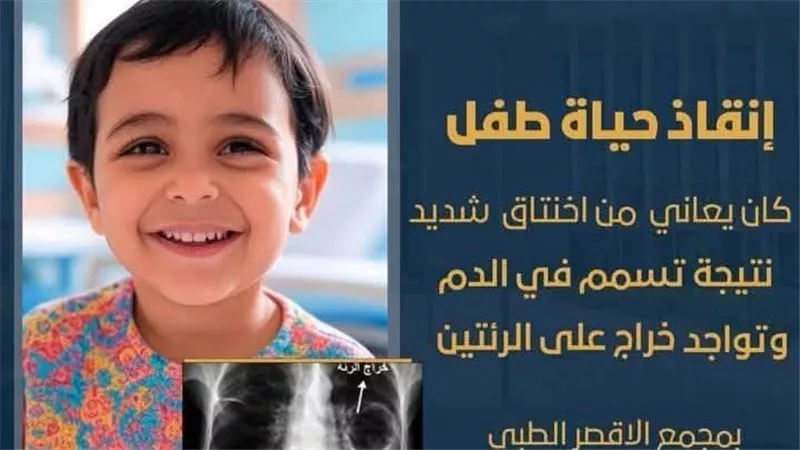 عملية جراحية دقيقة تنقذ حياة طفل بمجمع الأقصر الطبي
