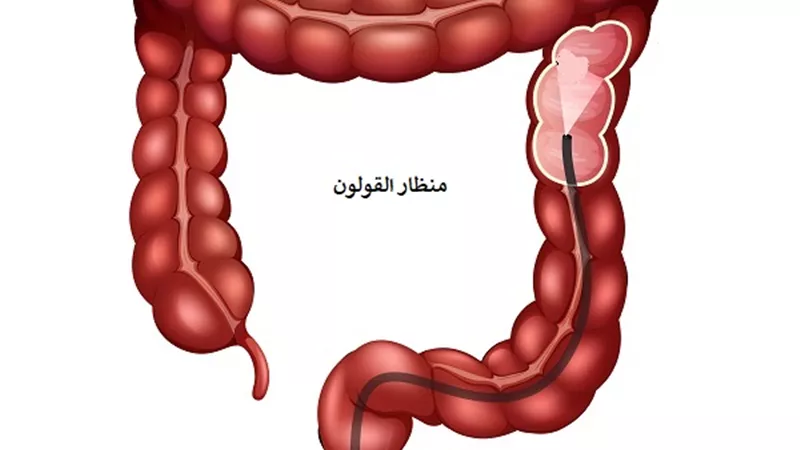 تشابه الأعراض قد يكون خادعًا: كيف تميّز بين الزائدة الدودية والقولون العصبي؟