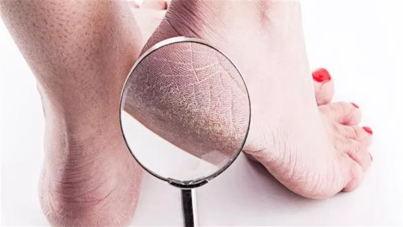 منها زيت الزيتون والسكر الخشن والعسل..حلول سحرية للقضاء على تشقق الكعبين