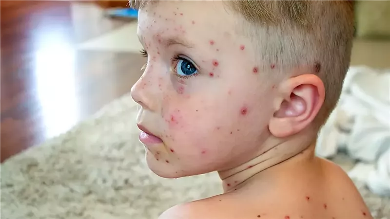 اكتشفيه مبكرًا.. 3 مراحل يمر بها الجدري المائي عند إصابة طفلك به