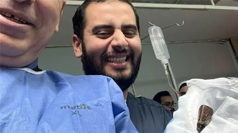 بعد عام ونصف من ابتلاعها.. استخراج 3 حجارة قلم من بطن مريض بالمنوفية