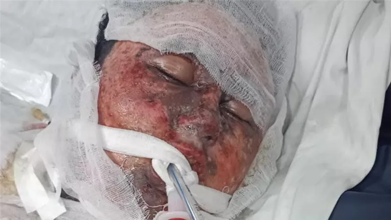 أصيب في حريق شبر الخيمة.. أسرة شاب تستغيث بالرئيس السيسي لنقله لمستشفى أهل مصر