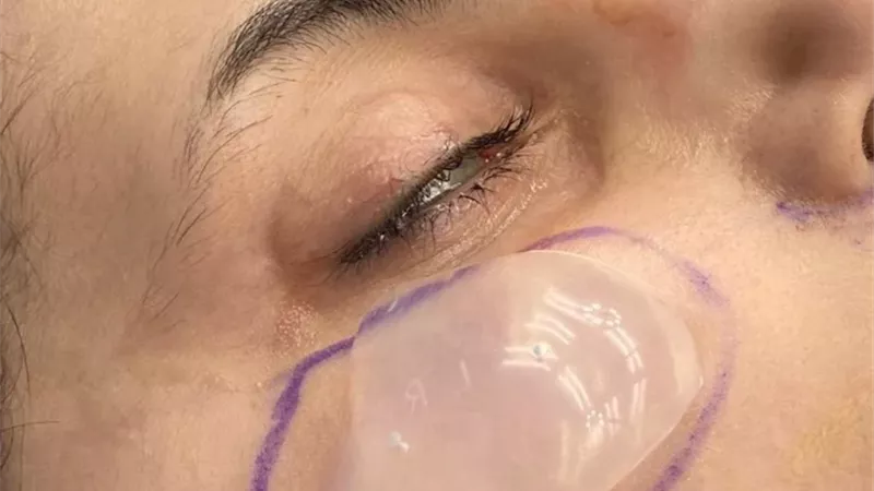 زرع غمازات الخدين.. موضة تجميلية تنتشر بصورة سريعة