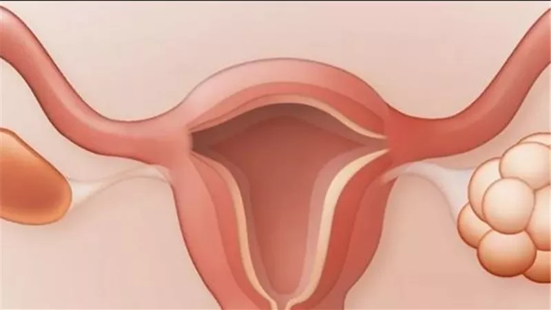 دليلك الشامل لفهم تكيسات المبايض.. الأعراض والعلاج والوقاية منه