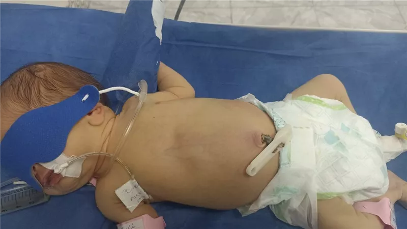 إنقاذ حياة طفلة رضيعة تعاني من انسداد معوي بالمنوفية
