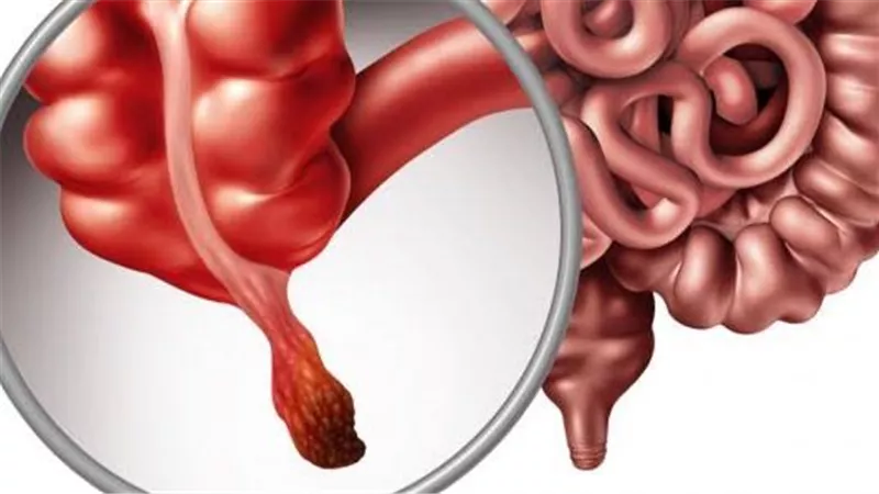 التهاب الزائدة الدودية.. الأعراض والأسباب وطرق العلاج