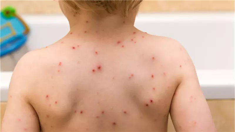 مع اقتراب بدء الدراسة .. كيف تحمي طفلك من مرض الجدري وأسبابه وأعراضه؟