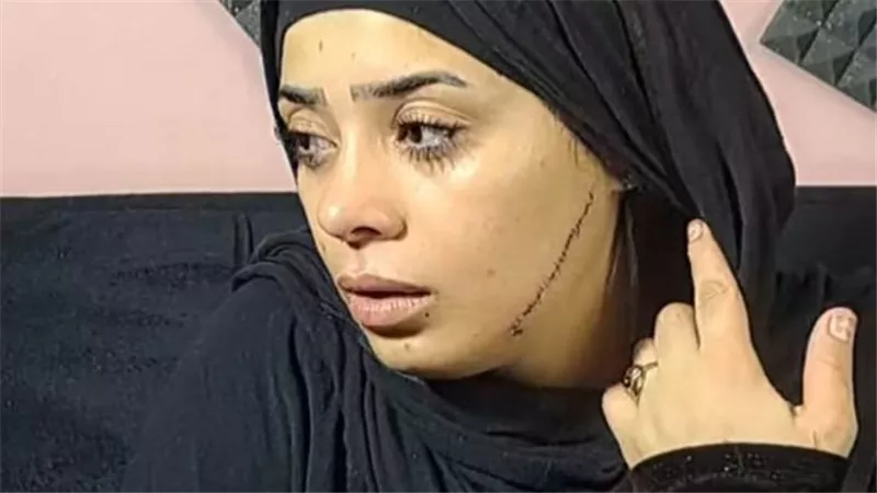 قصة «منصورة» المأساوية.. طليقة عريسها شوهت وجهها قبل زفافها 