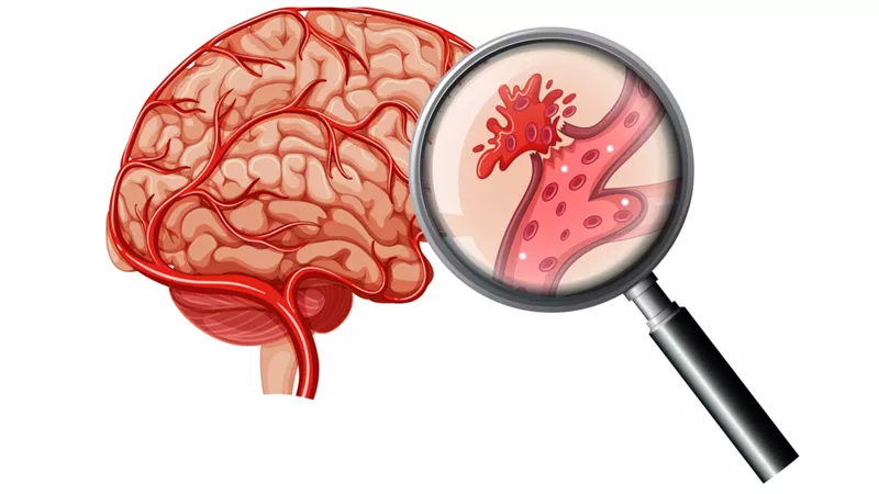 كل ما تريد معرفته عن السكتة الدماغية.. الأعراض والأسباب وطرق الوقاية