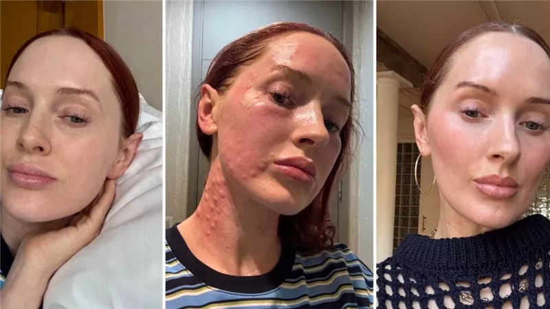 ترند التجميل بحقن الريجوران يتصدر ترند التيك توك وتحذيرات عالمية منه