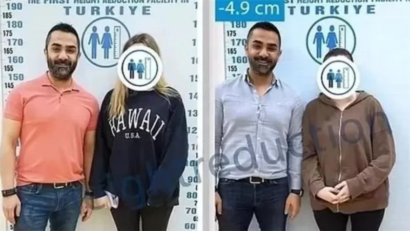 بحثًا عن شريك.. نساء يلجأن لجراحة تقصير الساقين في تركيا