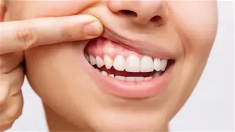 من الفم إلى القلب.. كيف تُسبب البكتيريا الفموية النوبات القلبية؟