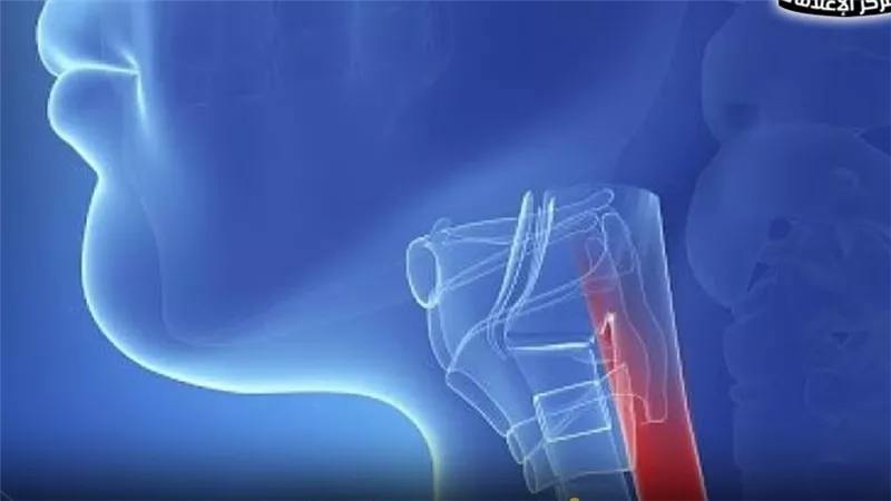 لأول مرة عالميًا.. علاج حالة أكالازيا مستعصية بنسبة 100%