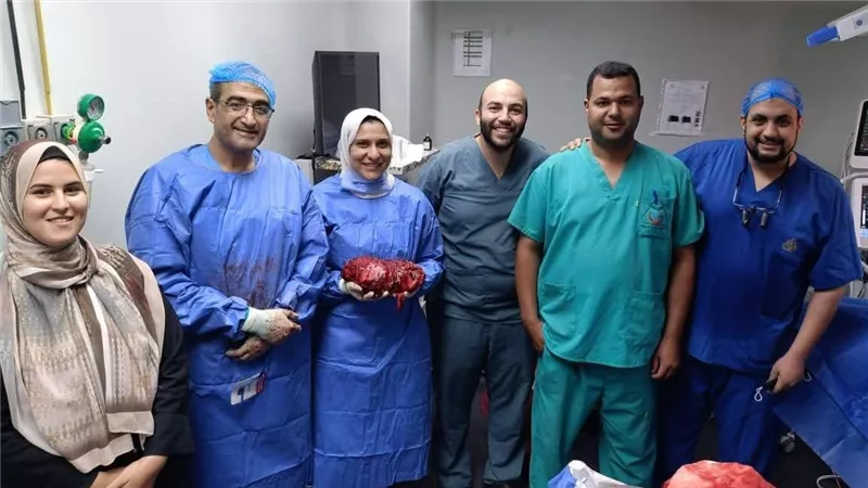 يزن 4 كيلو جرام.. نجاح فريق طبي بمستشفيات جامعة المنوفية في استئصال ورم 