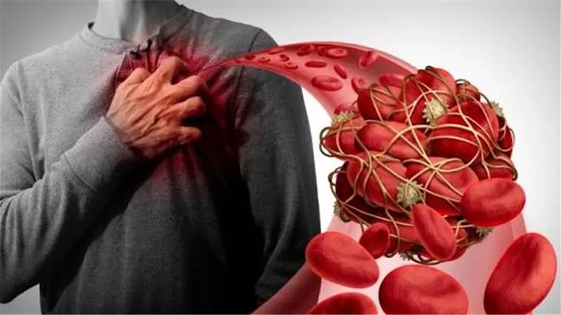 ليست الوراثة فقط.. 4 أسباب رئيسية وراء الجلطات وفق دراسة جديدة 	
