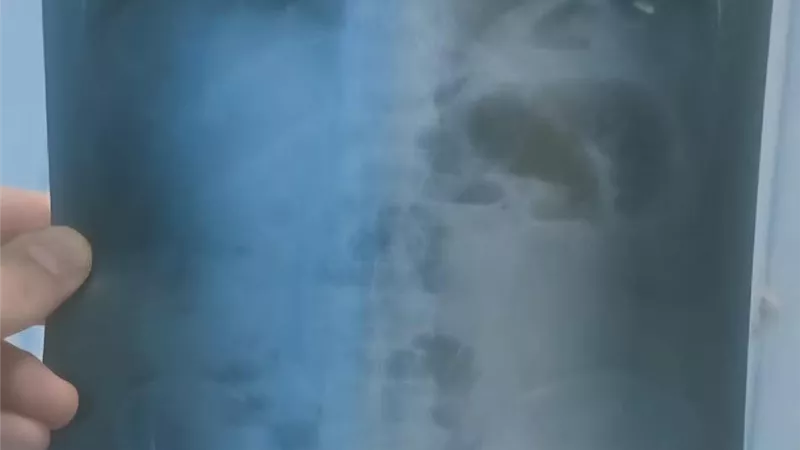 نجاح فريق طبي بمستشفى دمياط العام في إنقاذ مسن من فتق مختنق