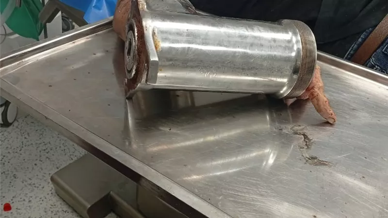 نزيف لا يتوقف.. مستشفى العجمي ينقذ شابا علقت يده في مفرمة لحوم