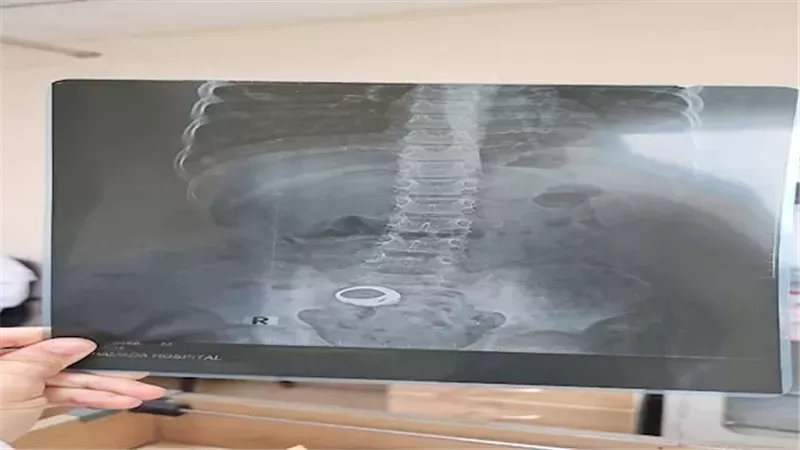 مناشدات للبحث عن طفل غادر مستشفى بالبحيرة والخاتم داخل بطنه