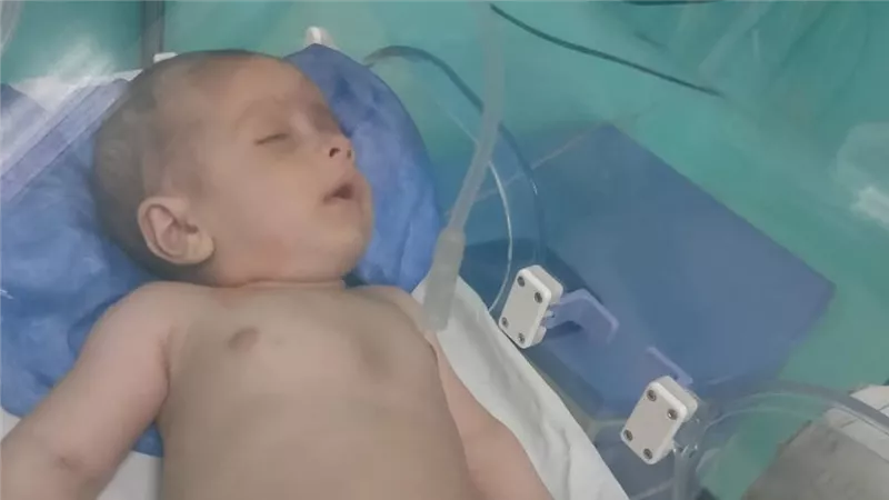 استعادة رضيع بالشرقية من الموت بعد محاولة اخته اطعامه تنرة توقفت بحلقه