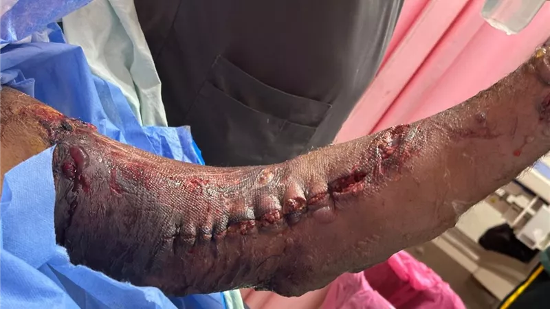 إنجاز طبي بسوهاج الجامعي.. الجراحات الميكروسكوبية تنقذ مصابين من بتر محقق