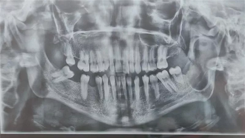 إنجاز طبي يحسب لدمياط.. جراحة معقدة تنهي معاناة مريض بورم بالفك السفلي