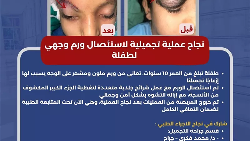 أطباء مستشفى أبوقير يحولون حياة طفلة للأفضل بعد إزالة تشوهات بوجهها