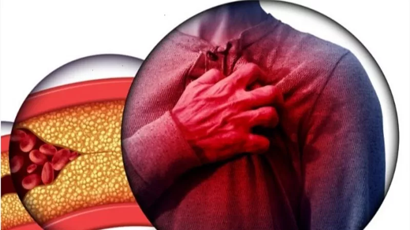 5 أسباب لتصلب الشرايين وأعراضه وطرق الوقاية للحفاظ على صحة القلب