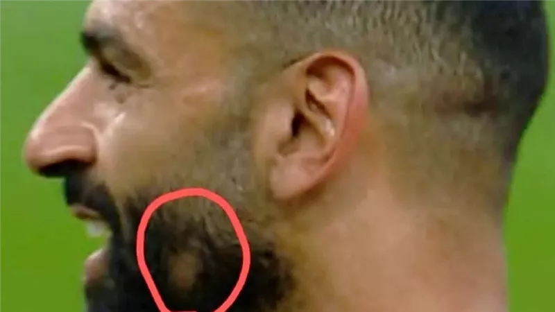 تساقط الشعر عند محمد صلاح يثير التساؤلات ..هل هي الثعلبة فعلًا؟