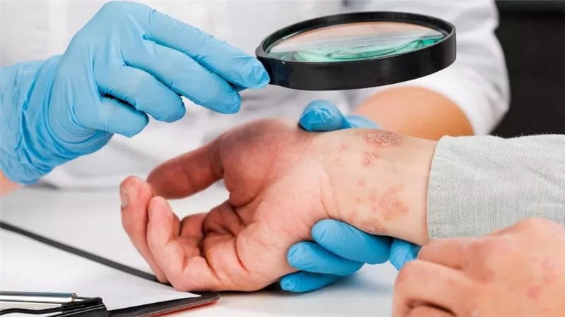 دراسة على مدار 25 عاما تكشف ارتباط الإكزيما بأمراض الأمعاء