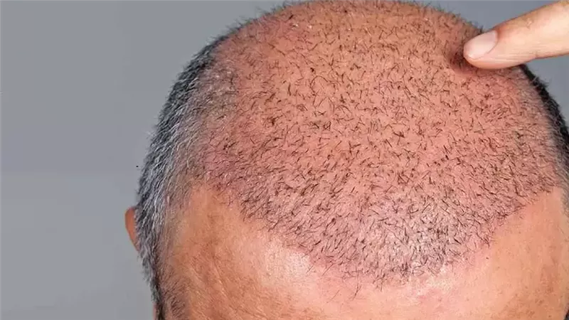 هل زراعة الشعر للرجل أو المرأة حلال شرعا؟ الشيخ أشرف عبد الجواد يجيب