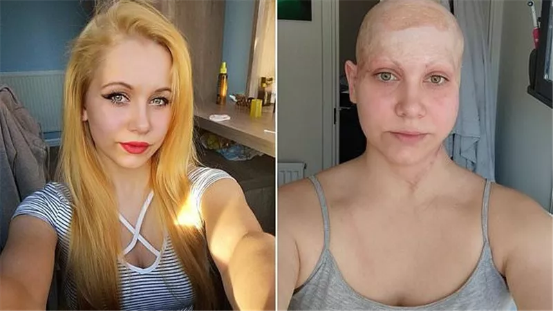 امرأة تفقد فروة رأسها بسبب حادث عمل وأطفالها لا يتعرفون عليها دون الباروكة 