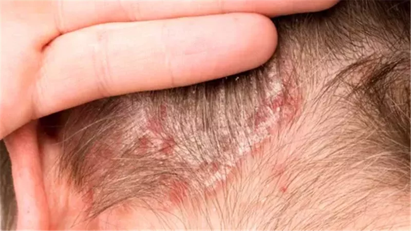 علاج أكزيما الشعر.. كيفية تهدئة وعلاج التهاب فروة الرأس بشكل طبيعي؟