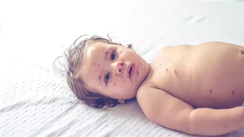 مع تزايد حالات الإصابة بالحصبة في لندن.. العلامات التي يجب الانتباه إليها