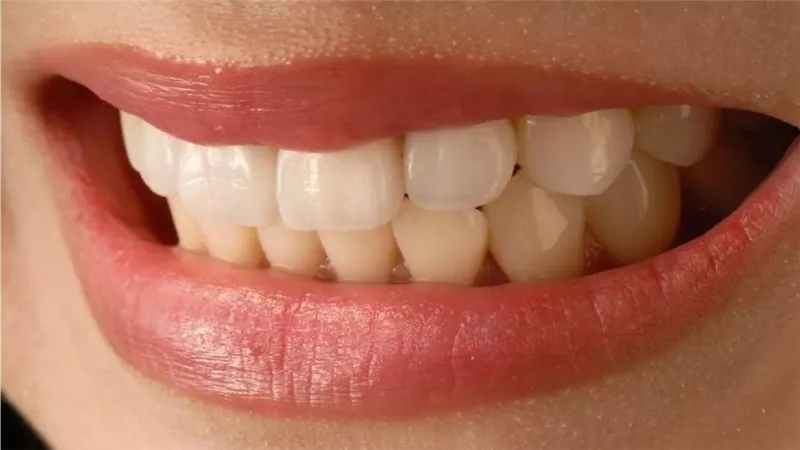 من الأبيض إلى الأصفر .. ما يعكسه لون أسنانك عن صحتك 	
