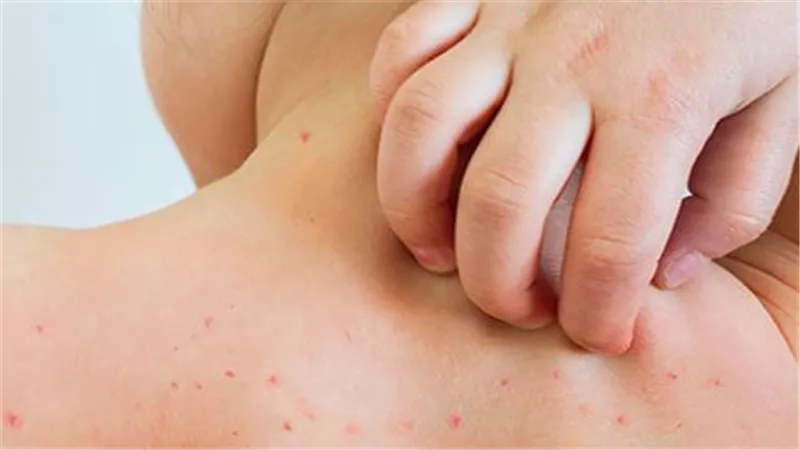 تفشي الحصبة.. علامات تحذيرية مبكرة لدى الأطفال وطرق حمايتهم