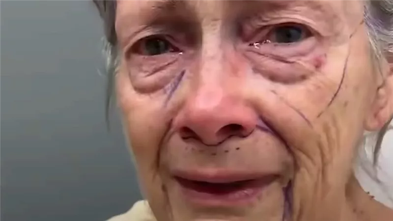 جراح تجميل يعيد لامرأة سبعينية شبابها بعد عملية شد الوجه 
