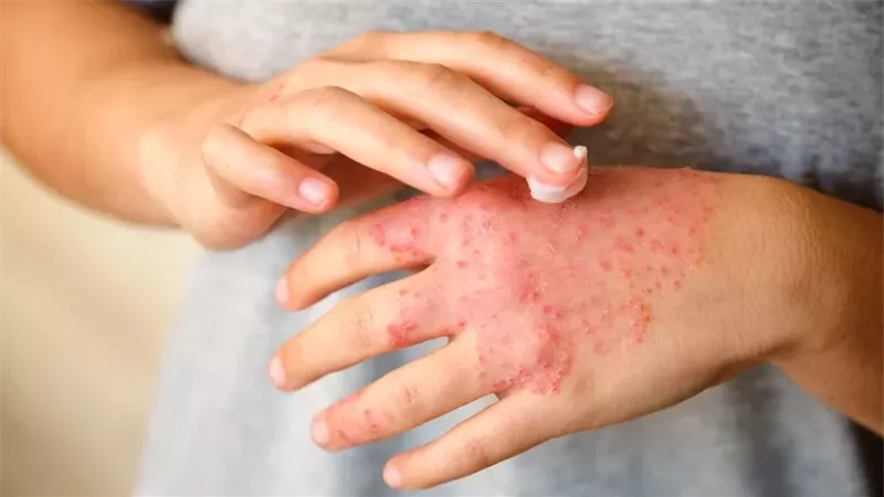 دراسة علمية.. الإجهاد النفسي والتوتر يجعل الإكزيما أسوأ