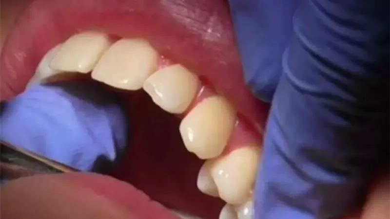 ما علاقة سن اليأس بنزيف اللثة وضعف الأسنان عند النساء ؟